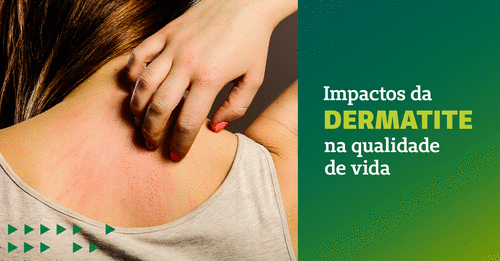 Impactos da dermatite na qualidade de vida
